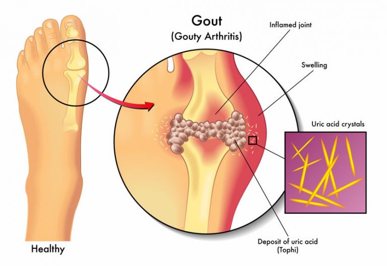 PTCB Guide to Antigout Drugs!